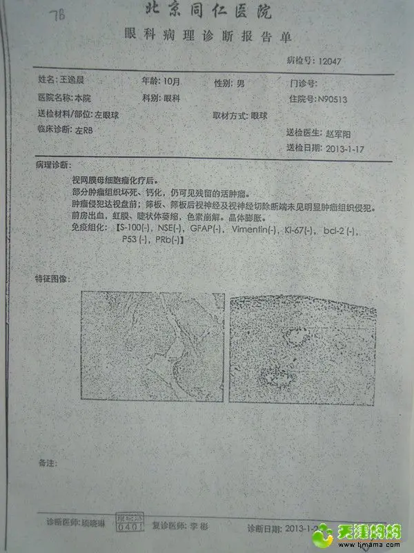 左眼的肿瘤已经被手术切除(付出了眼球的代价,病理结果如下